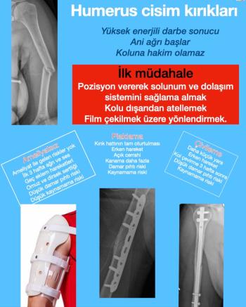 Humerus cisim kırıkları