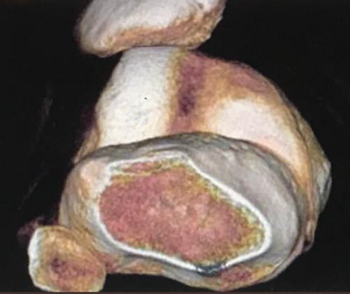Patella (Diz kapağı) Çıkığı